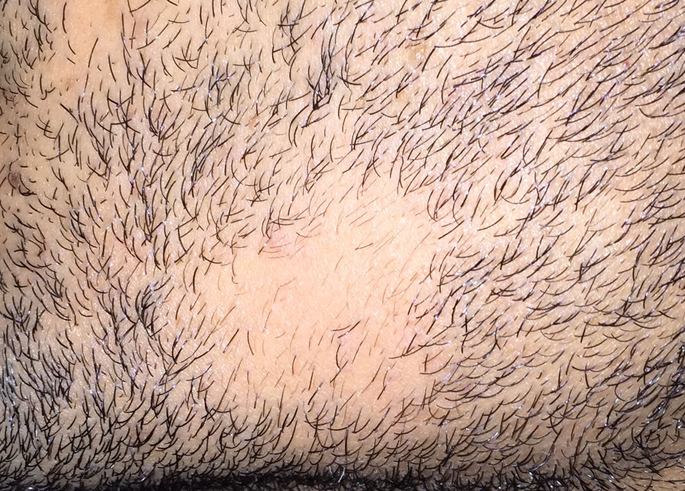 bald-spot-beard-alopecia-areata-barbae-3